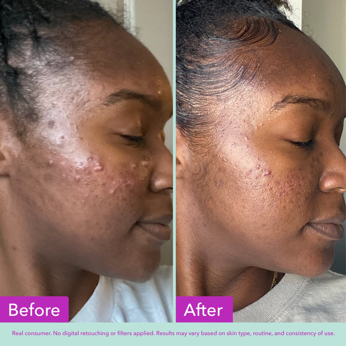 acne-foaming-cleanser-s2 zb_p.jpg