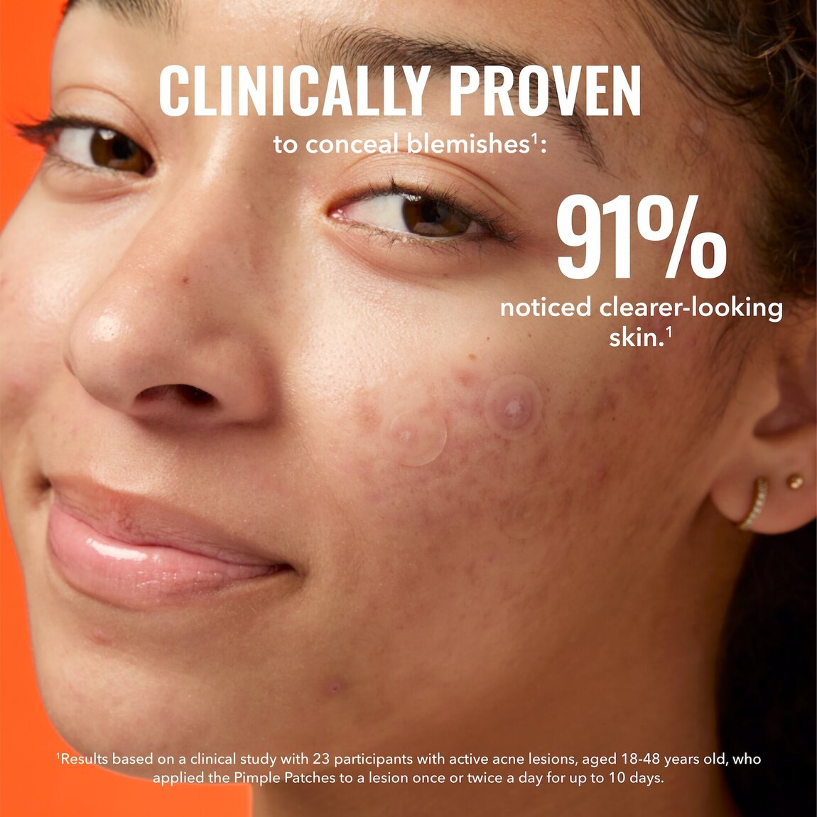 pimple-patches-e8 zb_p.jpg